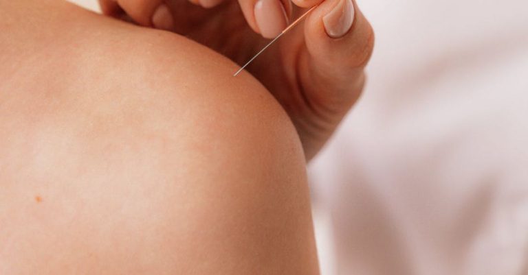 Acupuncture - Acupuncturist Putting Needles on the Shoulder of a Person