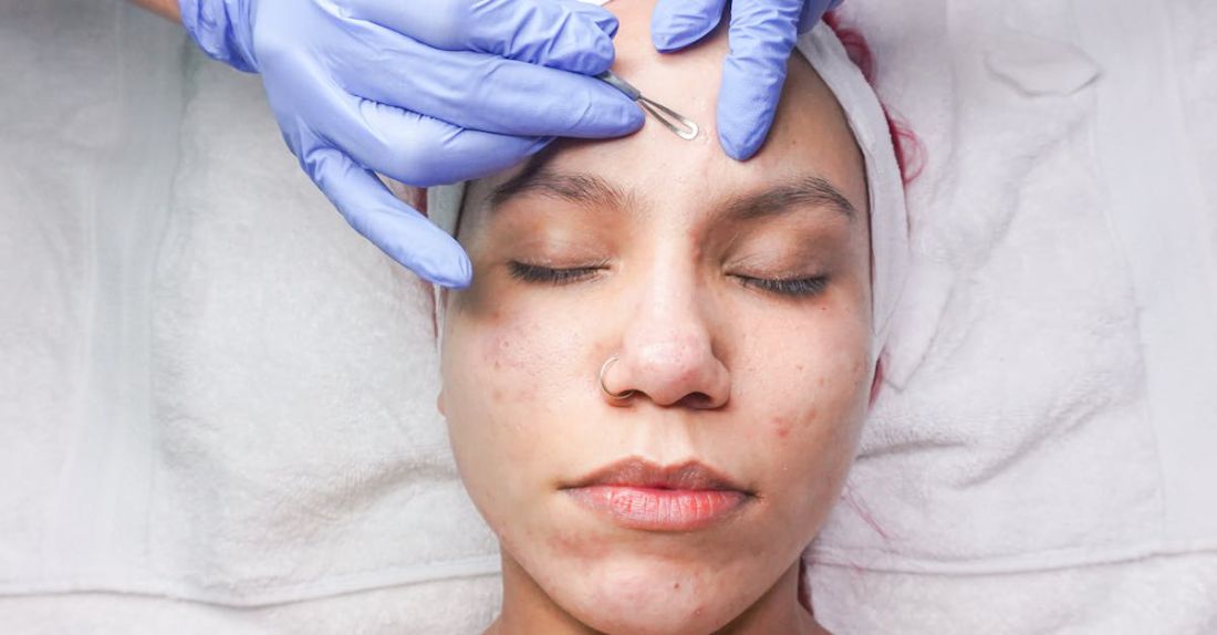 Acne Remedies - spa