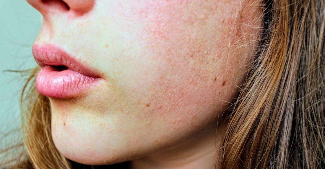 Dry Skin - Close View of Womans Face